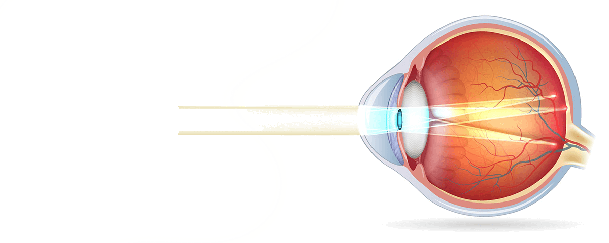 Que es la miopia el astigmatismo y la presbicie o hipermetropia que diferencias hay y como ve una persona